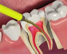 PERAWATAN SALURAN AKAR